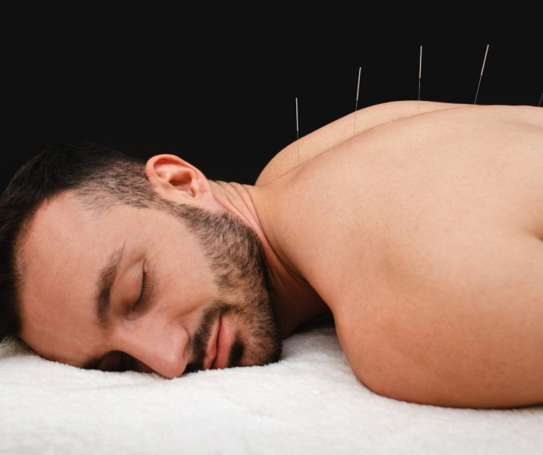 Akupunktura – co to jest, jak działa i na co pomaga?
